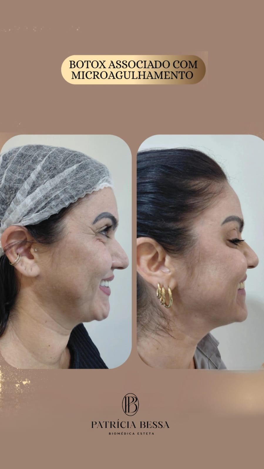 Botox associado a microagulhamento