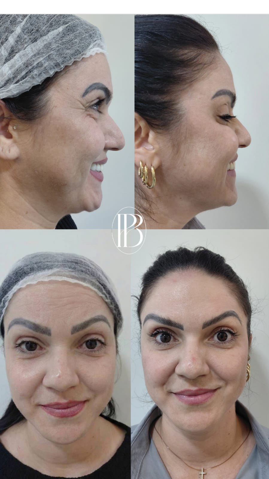 Rejuvenescimento facial
